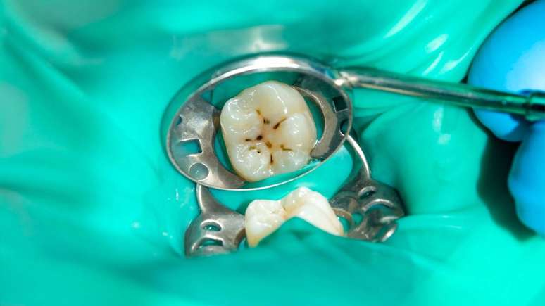 A avaliação periódica de dentes restaurados com amálgama é recomendada para garantir a saúde bucal e prevenir problemas maiores – depositphotos.com / schigirin91@gmail.com