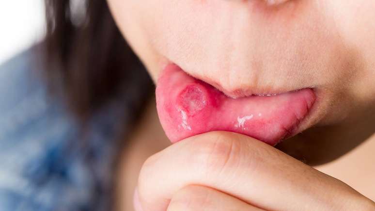 Aftas costumam surgir na língua, bochechas, lábios ou gengiva – depositphotos.com / leungchopan