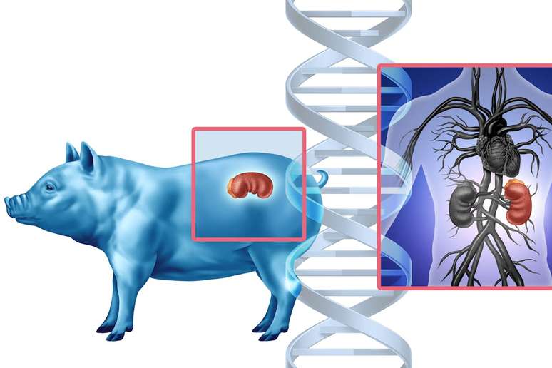 Enquanto a pesquisa sobre quimeras humano-suínas está em uma pausa indefinida, o xenotransplante segue avançando com o uso de órgão suínos editados geneticamente para serem "mais humanos". wildpixel/iStock via Getty Images Plus