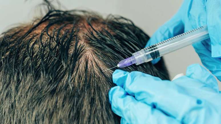 Adiar a avaliação com médico ou outro profissional habilitado é um erro que se repete em muitos casos de queda de cabelo – depositphotos.com / Kinderkz