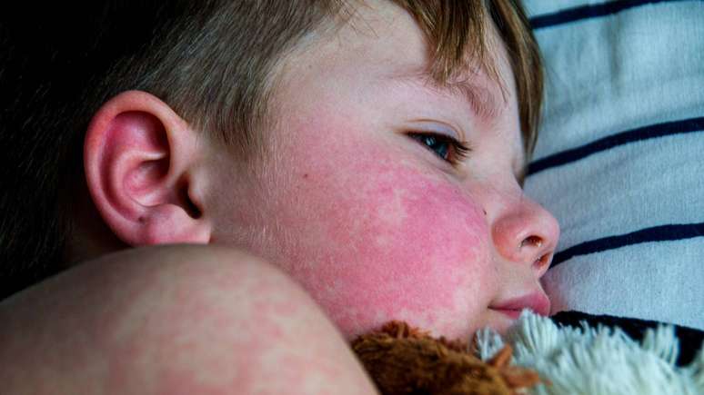 rubéola – depositphotos.com / milastokerpro