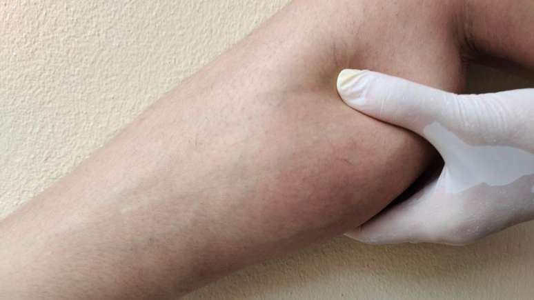 Does heat make lipedema worse?