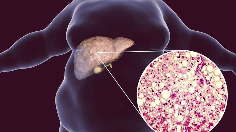 A gordura no f&iacute;gado com inflama&ccedil;&atilde;o ocorre quando h&aacute; ac&uacute;mulo excessivo de gordura nas c&eacute;lulas hep&aacute;ticas, acompanhado de um processo inflamat&oacute;rio persistente &ndash; depositphotos.com / katerynakon