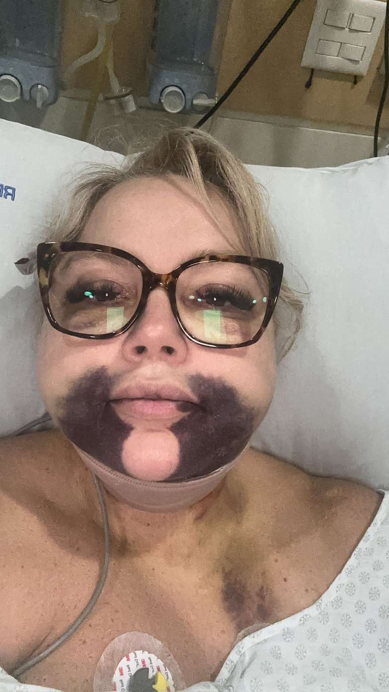 Eloah ficou internada por 12 dias e, depois, precisou fazer procedimentos para evitar a necrose da regi&atilde;o