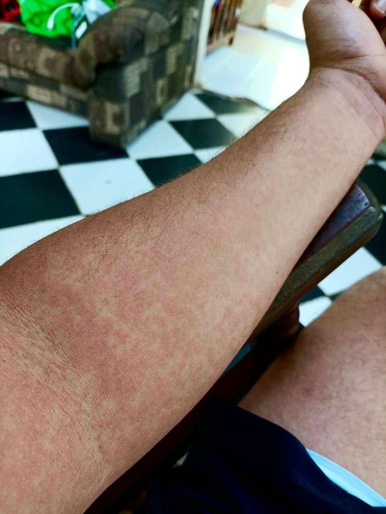 Ap&oacute;s v&aacute;rios dias de dores e febre, Hansel apresentou manchas na pele por todo o corpo