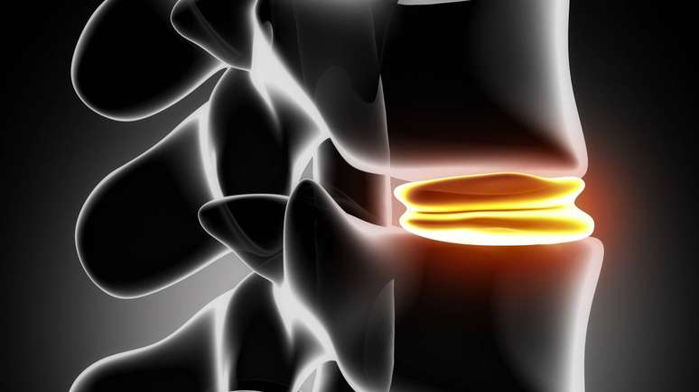 பல ஹெர்னியேட்டட் டிஸ்க் வலி தாக்குதல்கள் பழமைவாத நடவடிக்கைகளால் மேம்பட்டாலும், சில அறிகுறிகளுக்கு விரைவான மதிப்பீடு தேவைப்படுகிறது -