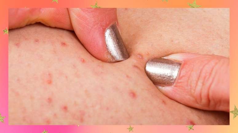 Tudo o que voc&ecirc; precisa saber para evitar pelos encravados