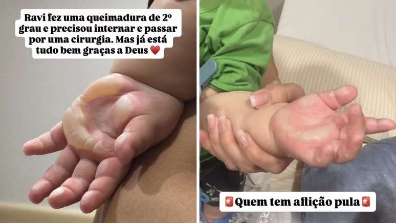 Imagem &eacute; forte: Viih Tube compartilhou foto da m&atilde;o do filho com queimadura, coberta de bolhas