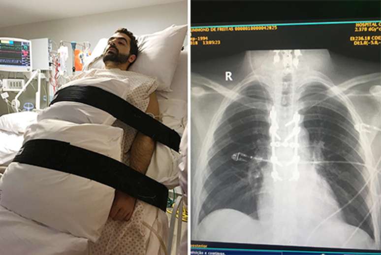 Anvisa libera estudo cl&iacute;nico da polilaminina, subst&acirc;ncia que pode ajudar na recupera&ccedil;&atilde;o da les&atilde;o medular