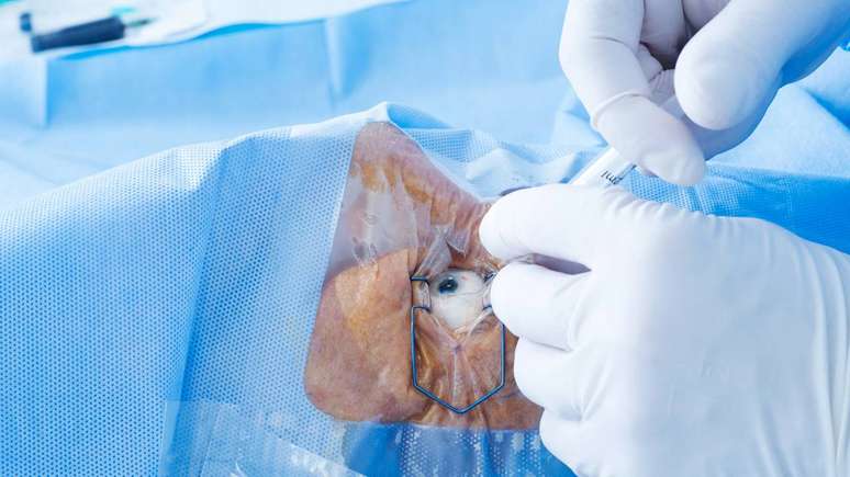 De forma geral, os tratamentos podem ser divididos em abordagens medicamentosas, procedimentos localizados na superf&iacute;cie ocular e cirurgias mais complexas, como o transplante corneano &ndash; depositphotos.com / Goir