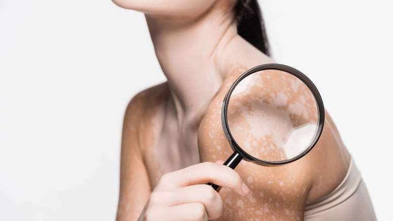 O acompanhamento do vitiligo &eacute; geralmente conduzido por dermatologista, que avalia a evolu&ccedil;&atilde;o das manchas, ajusta as medica&ccedil;&otilde;es e orienta cuidados cotidianos &ndash; depositphotos.com / VitalikRadko