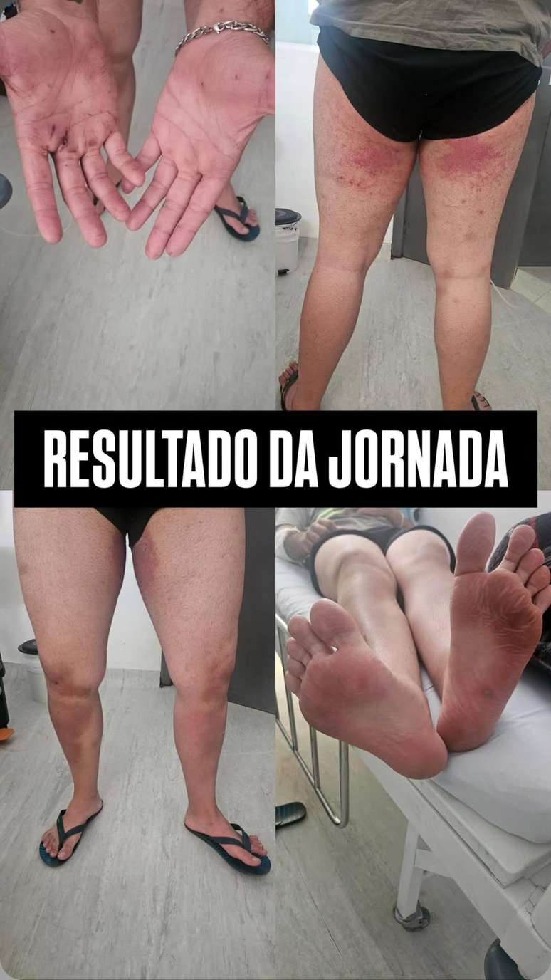 Irm&atilde; de jovem que se perdeu em trilha no Pico Paran&aacute; divulga imagens das les&otilde;es