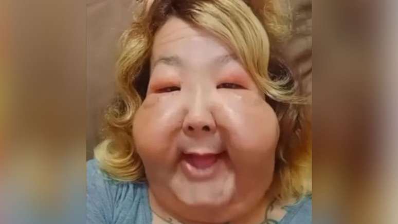 Juliana teve deforma&ccedil;&atilde;o no rosto ap&oacute;s aplica&ccedil;&atilde;o de &oacute;leo mineral em cl&iacute;nica clandestina