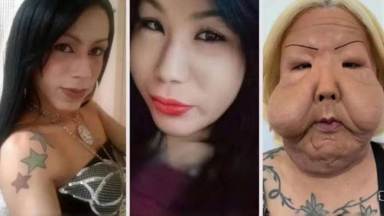 Juliana Oliveira antes, logo ap&oacute;s e um tempo depois do procedimento malsucedido usando &oacute;leo mineral no rosto