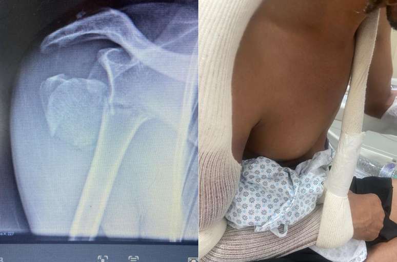 Wellington Val&eacute;rio teve o ombro quebrado durante a confus&atilde;o