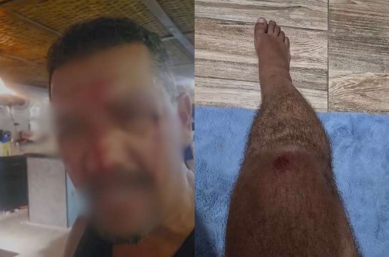 Al&eacute;m do rosto, a v&iacute;tima tamb&eacute;m teve a perna ferida na queda ap&oacute;s o soco