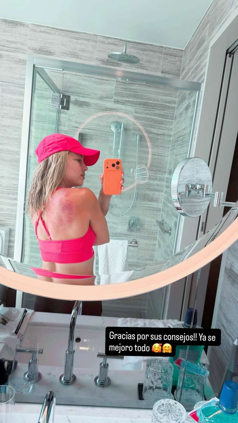 Costas de Renata Zarazua ap&oacute;s tratamento 