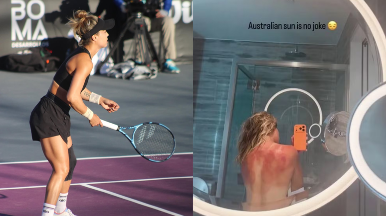 Tenista mexicana exp&otilde;e queimaduras de sol ap&oacute;s torneio na Austr&aacute;lia e alerta para riscos