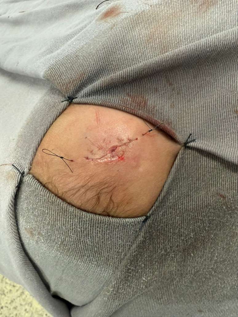 Foto do cr&aacute;nio da crian&ccedil;a p&oacute;s-cirurgia no Hospital S&atilde;o Jo&atilde;o de Deus