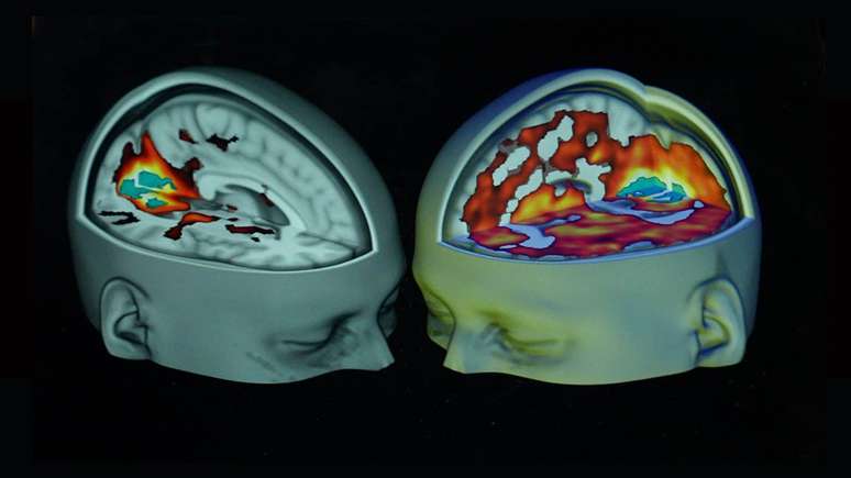 Compara&ccedil;&atilde;o de imagens do c&eacute;rebro hiperativo de um usu&aacute;rio de psicod&eacute;licos, ao lado de algu&eacute;m que n&atilde;o ingeriu a subst&acirc;ncia