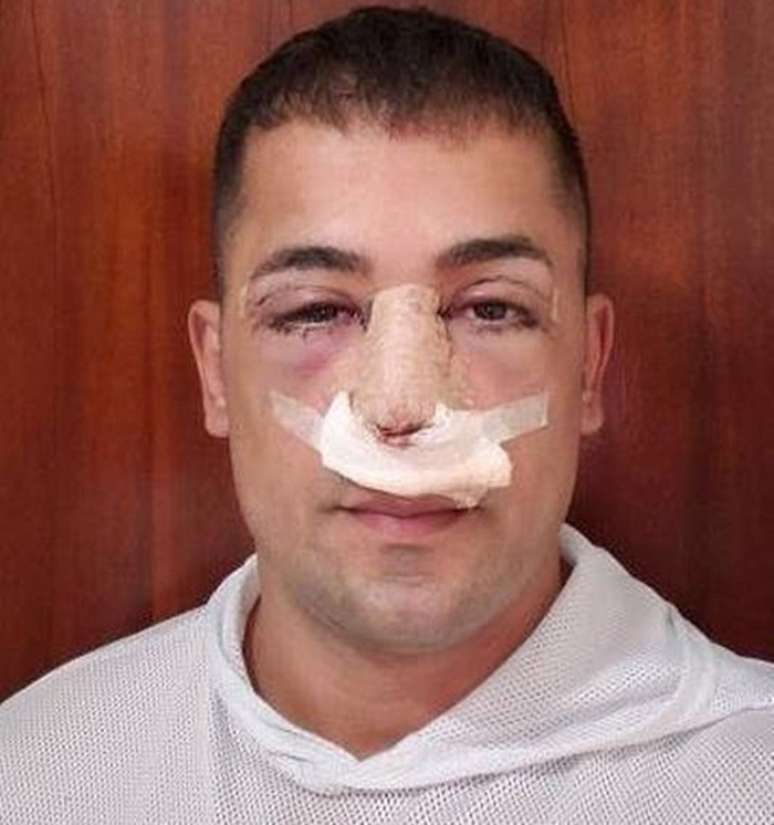 Tiago Piquilo engrossou o &oacute;rg&atilde;o genital, fez lipos no abd&ocirc;men e tamb&eacute;m mexeu em partes do rosto