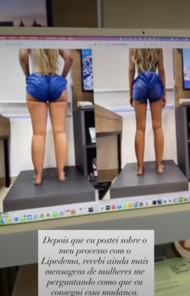 Yasmin Brunet mostra antes e depois de transforma&ccedil;&atilde;o corporal com tratamento de lipedema e anuncia curso