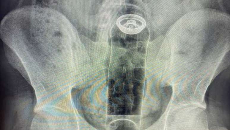 Paciente introduziu desodorante no reto e precisou de cirurgia para remover objeto