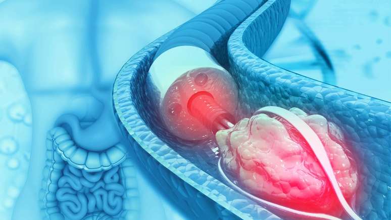 O tratamento dos c&aacute;lculos renais varia conforme o tamanho da pedra, o tipo de c&aacute;lculo, a intensidade dos sintomas e a presen&ccedil;a de complica&ccedil;&otilde;es &ndash; depositphotos.com / crytallight