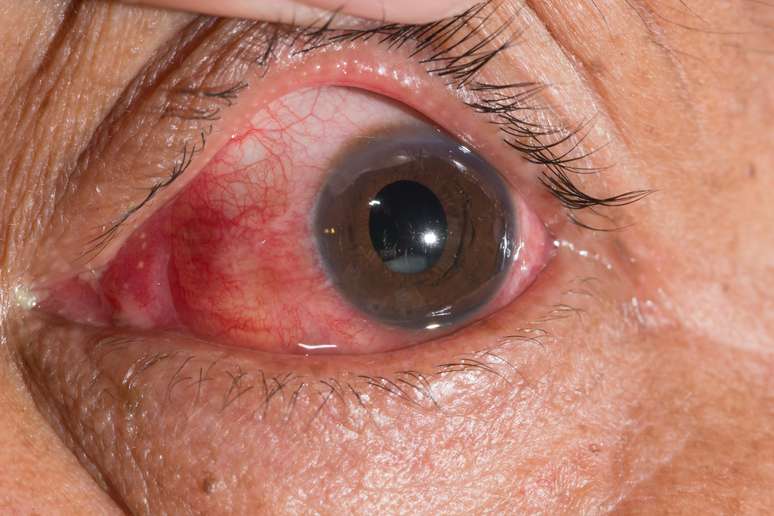 De acordo com a Organiza&ccedil;&atilde;o Mundial da Sa&uacute;de (OMS), a catarata &eacute; respons&aacute;vel por cerca de 51% dos casos de cegueira no mundo.