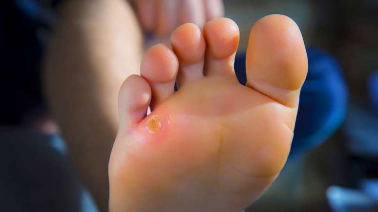 O cuidado come&ccedil;a com medidas simples: trocar o cal&ccedil;ado, hidratar os p&eacute;s diariamente e reduzir a fric&ccedil;&atilde;o com palmilhas ou protetores &ndash; depositphotos.com / Hriana