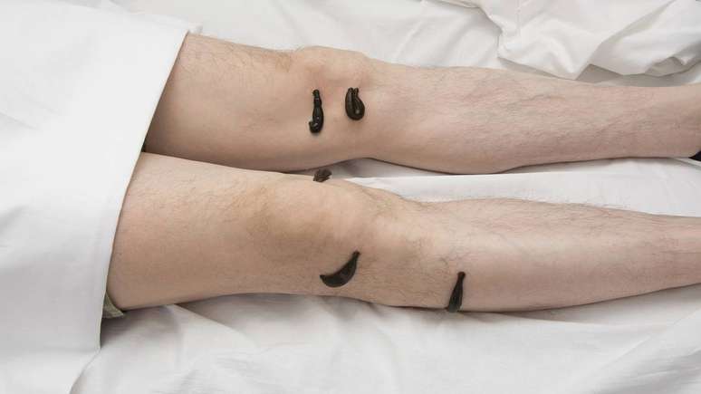 Os principais benef&iacute;cios das sanguessugas medicinais est&atilde;o relacionados &agrave; melhora tempor&aacute;ria da circula&ccedil;&atilde;o venosa em &aacute;reas comprometidas &ndash; depositphotos.com / sdigitall