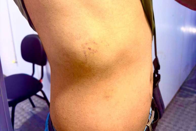 Jo&atilde;o Vitor mostra hematomas durante exame do corpo de delito