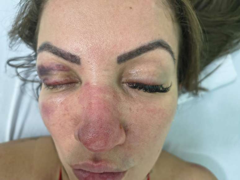 Vereadora diz ter sido agredida por namorado antes de atropel&aacute;-lo em Embu das Artes