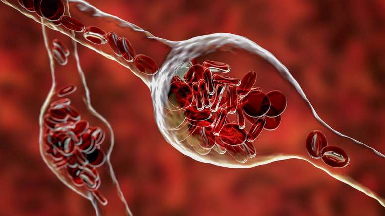 Exames laboratoriais, como marcadores inflamat&oacute;rios, podem ser solicitados para afastar outras condi&ccedil;&otilde;es associadas &ndash; depositphotos.com / katerynakon