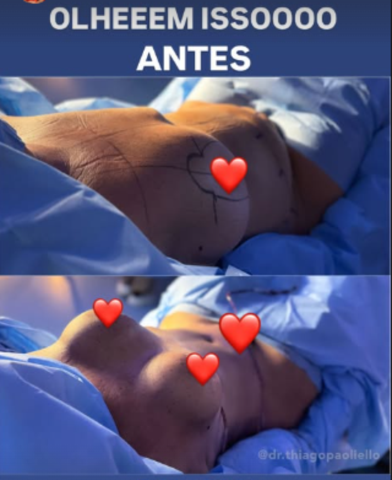 Virginia posta antes e depois do corpo da m&atilde;e ap&oacute;s cirurgias pl&aacute;sticas