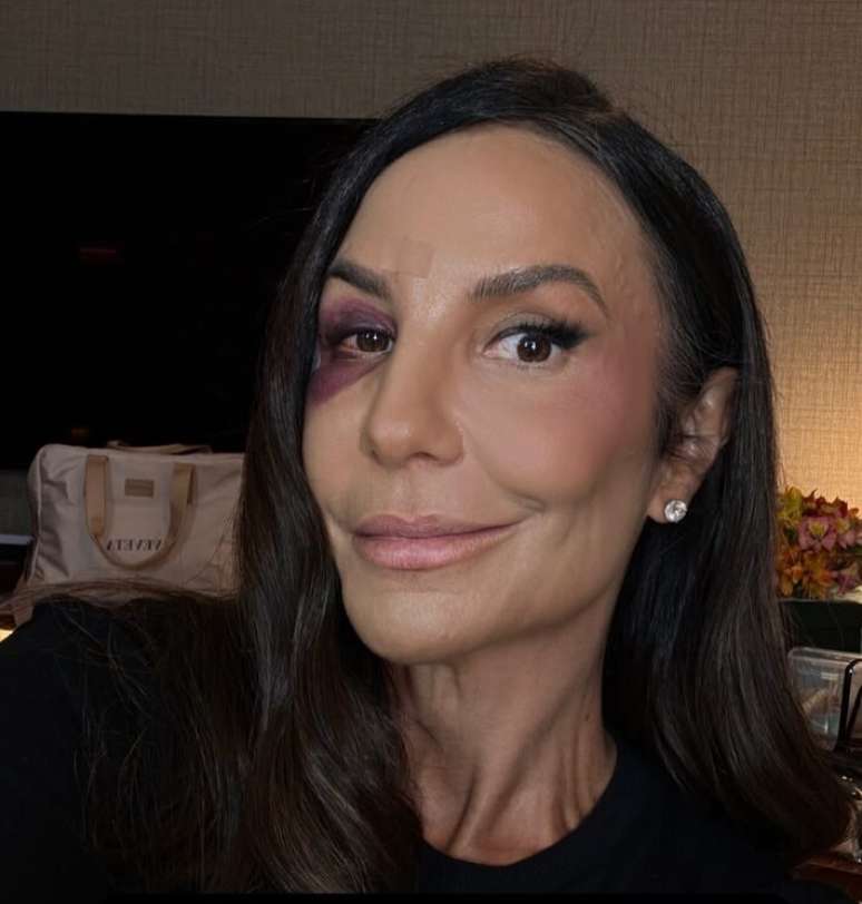 Ivete Sangalo recebe alta ap&oacute;s cirurgia no rosto.