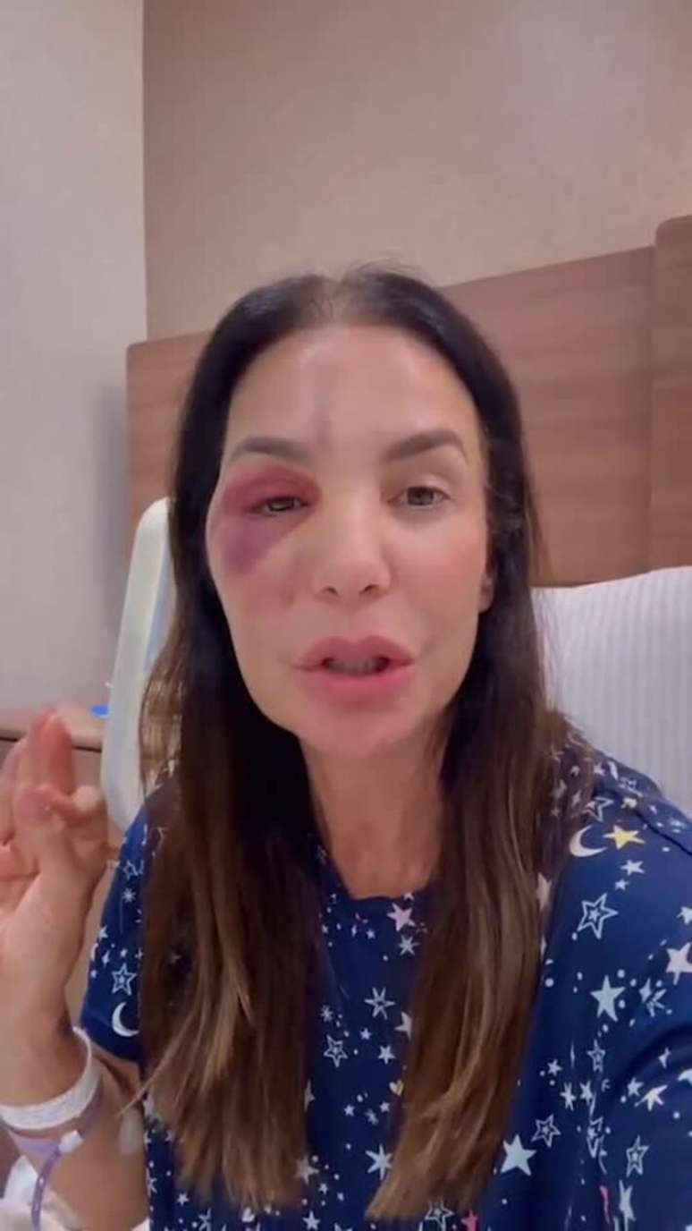 Ivete Sangalo fala sobre cirurgia no rosto ap&oacute;s queda em casa.