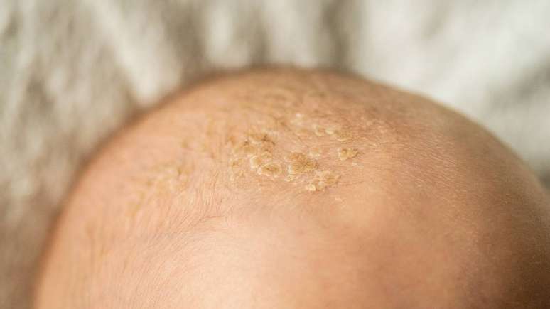 Fatores como calor, suor, oleosidade e roupas apertadas favorecem o aparecimento. N&atilde;o est&aacute; ligada &agrave; falta de higiene &ndash; depositphotos.com / Nastyaofly