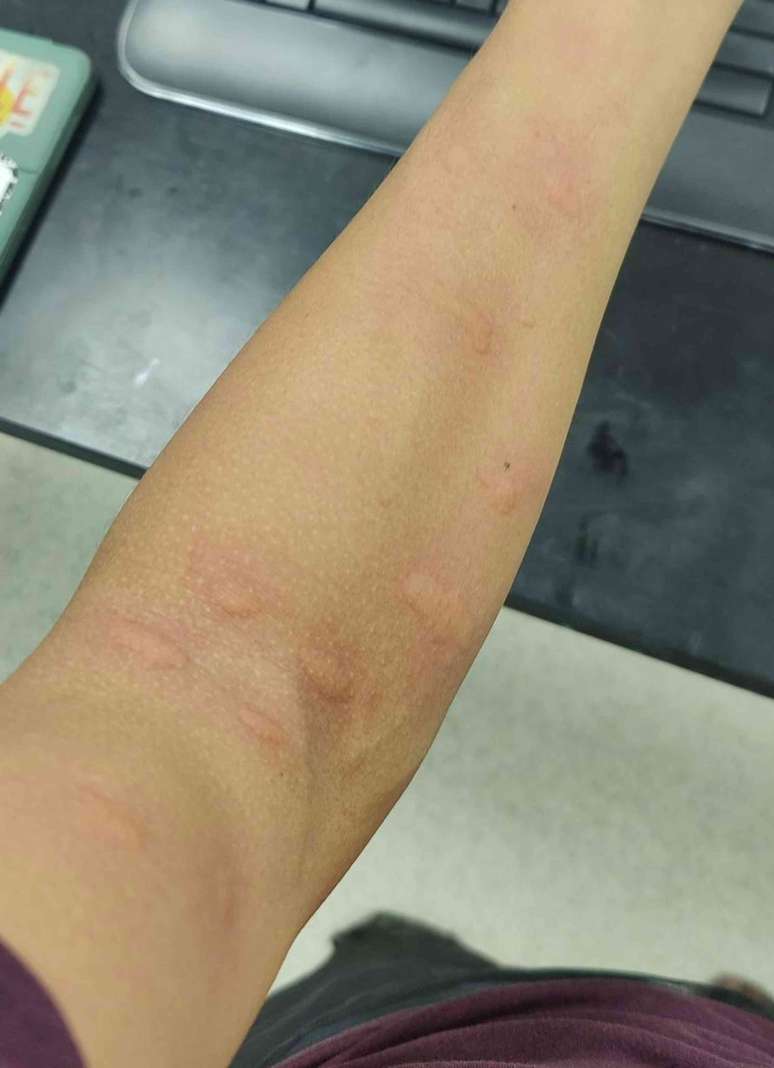 Bra&ccedil;o de um homem com v&aacute;rias marcas rosadas e salientes