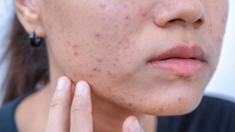 Acne na adolesc&ecirc;ncia e adulto: preven&ccedil;&atilde;o, rotina e quando procurar um dermatologista &ndash; depositphotos.com / maemodnit