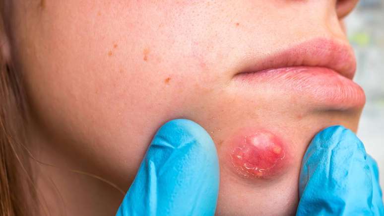 Na maior parte das vezes, o fur&uacute;nculo melhora com cuidados simples e, ap&oacute;s drenar o pus, tende a cicatrizar &ndash; depositphotos.com / andriano_cz