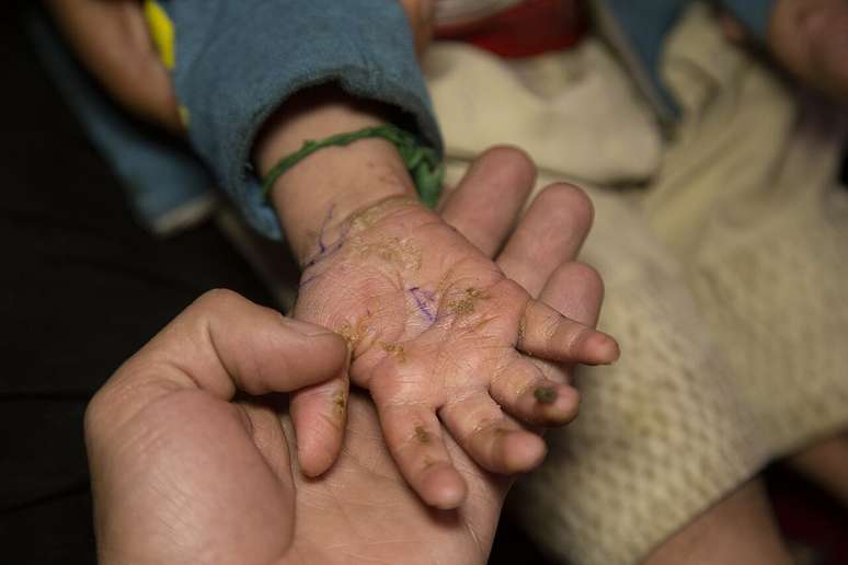 Os sintomas da epiderm&oacute;lise bolhosa variam conforme o tipo e a gravidade, mas todos envolvem algum grau de fragilidade extrema da pele &ndash; Mostafameraji/Wikimedia Commons