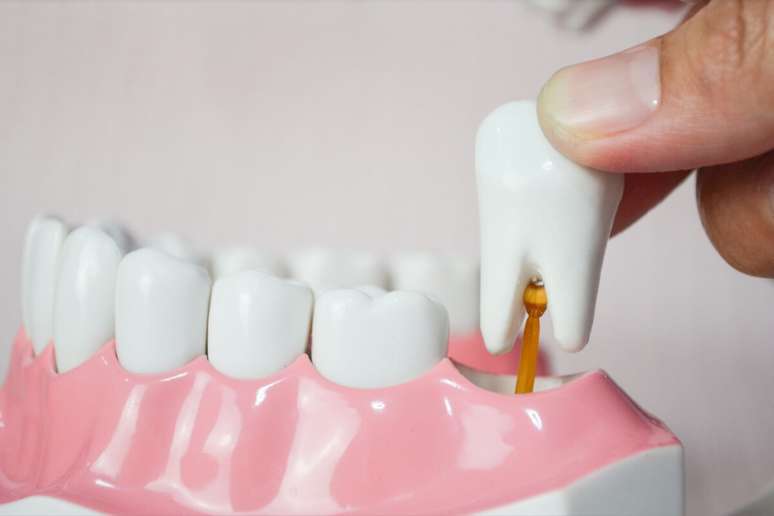 Nem todo dente do siso precisa ser removido, a n&atilde;o ser que esteja mal posicionado, ofere&ccedil;a dor ou cause risco a outros dentes 