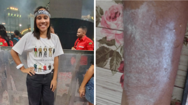 Nayara Silva relatou queimaduras ap&oacute;s uso de pulseira em show