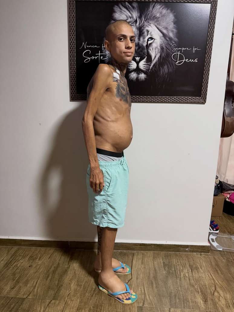 Jota Surfista perdeu peso por conta de c&acirc;ncer e ficou com a barriga inchada devido &agrave; cirrose