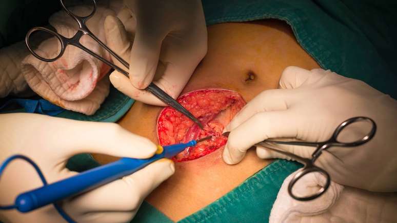 Na maior parte dos casos, a apendicectomia n&atilde;o provoca altera&ccedil;&otilde;es percept&iacute;veis a longo prazo &ndash; depositphotos.com / chanawit