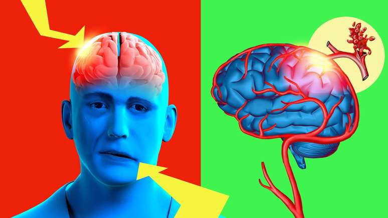 Isquemia cerebral -depositphotos.com / 100502500