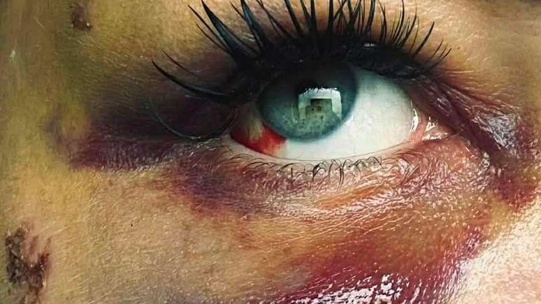 Anne Marie Boyle sofreu fratura de &oacute;rbita e do osso malar devido ao ataque