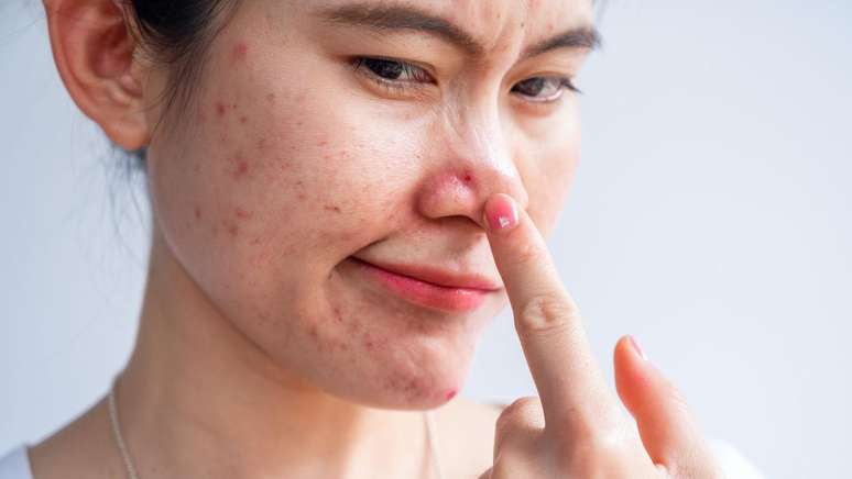 ఒత్తిడి చర్మంలోని గ్రంధులను ప్రేరేపిస్తుంది, ఇది సెబమ్ అనే జిడ్డు పదార్థాన్ని ఉత్పత్తి చేస్తుంది, ఇది రంధ్రాలను మూసుకుపోతుంది మరియు మొటిమలకు దోహదం చేస్తుంది.