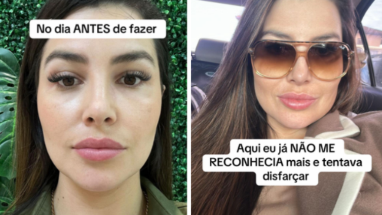 Influenciadora desabafou sobre procedimento est&eacute;tico que deu errado